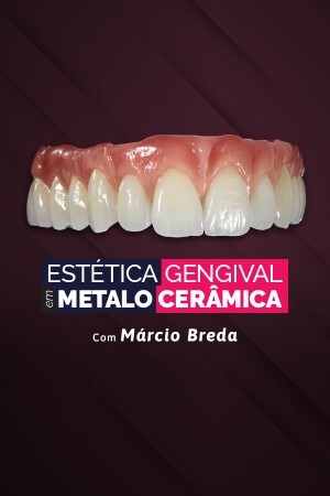 Estética Gengival em Metalo Cerâmica